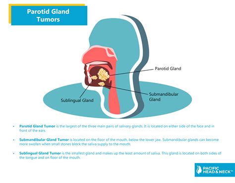 prada gland tumor|malignant parotid gland tumor.